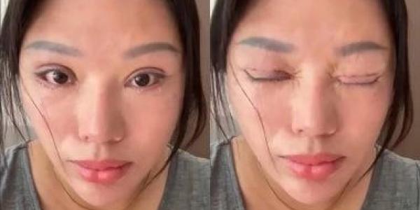 صينية تعجز عن إغلاق عينيها بعد جراحة تجميل فاشلة وتلزم بدفع تعويض للطبيب