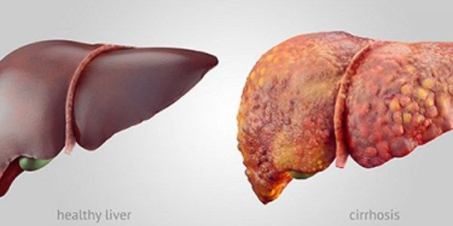 عقار واعد قد يغير مستقبل علاج الكبد الدهني.. دراسة تكشف نتائج مشجعة